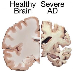 Alzheimers_brain