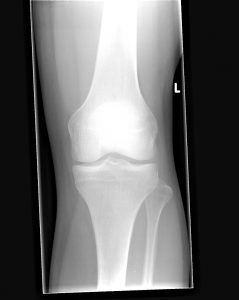Knee_Front_X-ray
