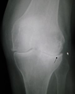 Osteoarthritis_left_knee