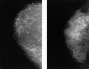 A fatty breast and a dense breast. Photo public domain